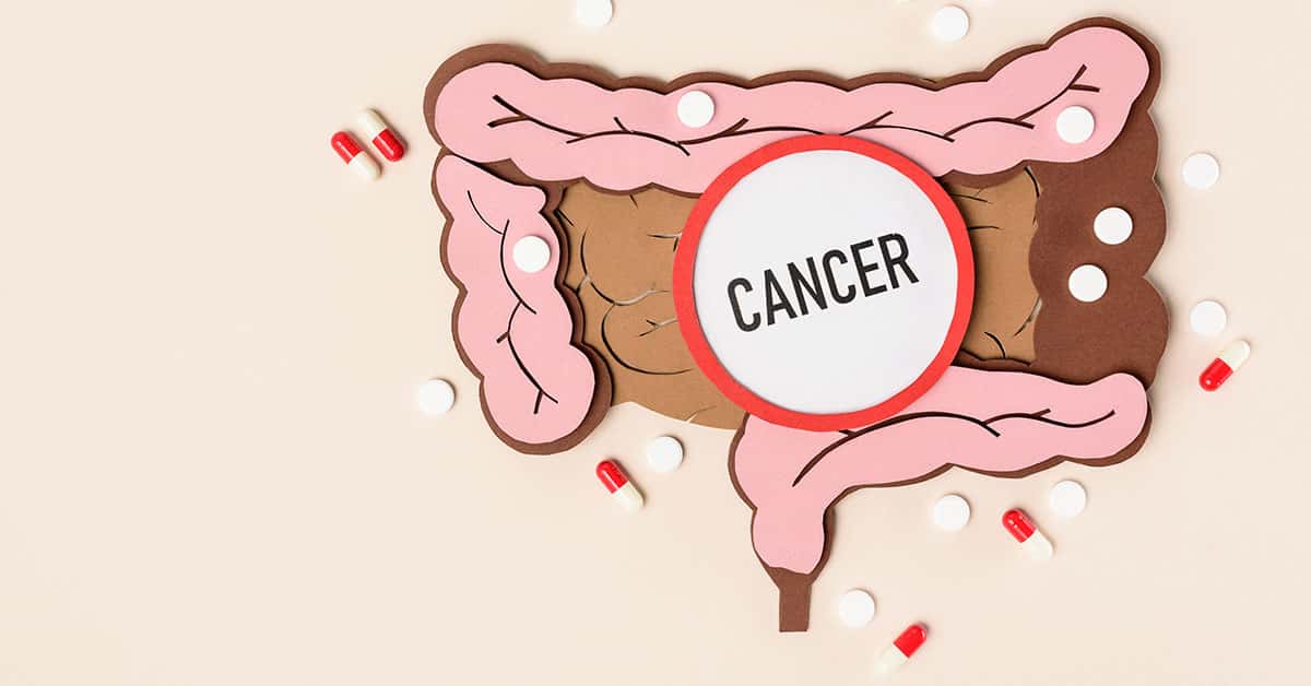 Câncer colorretal: sintomas são sangue nas fezes, cólicas e até fadiga